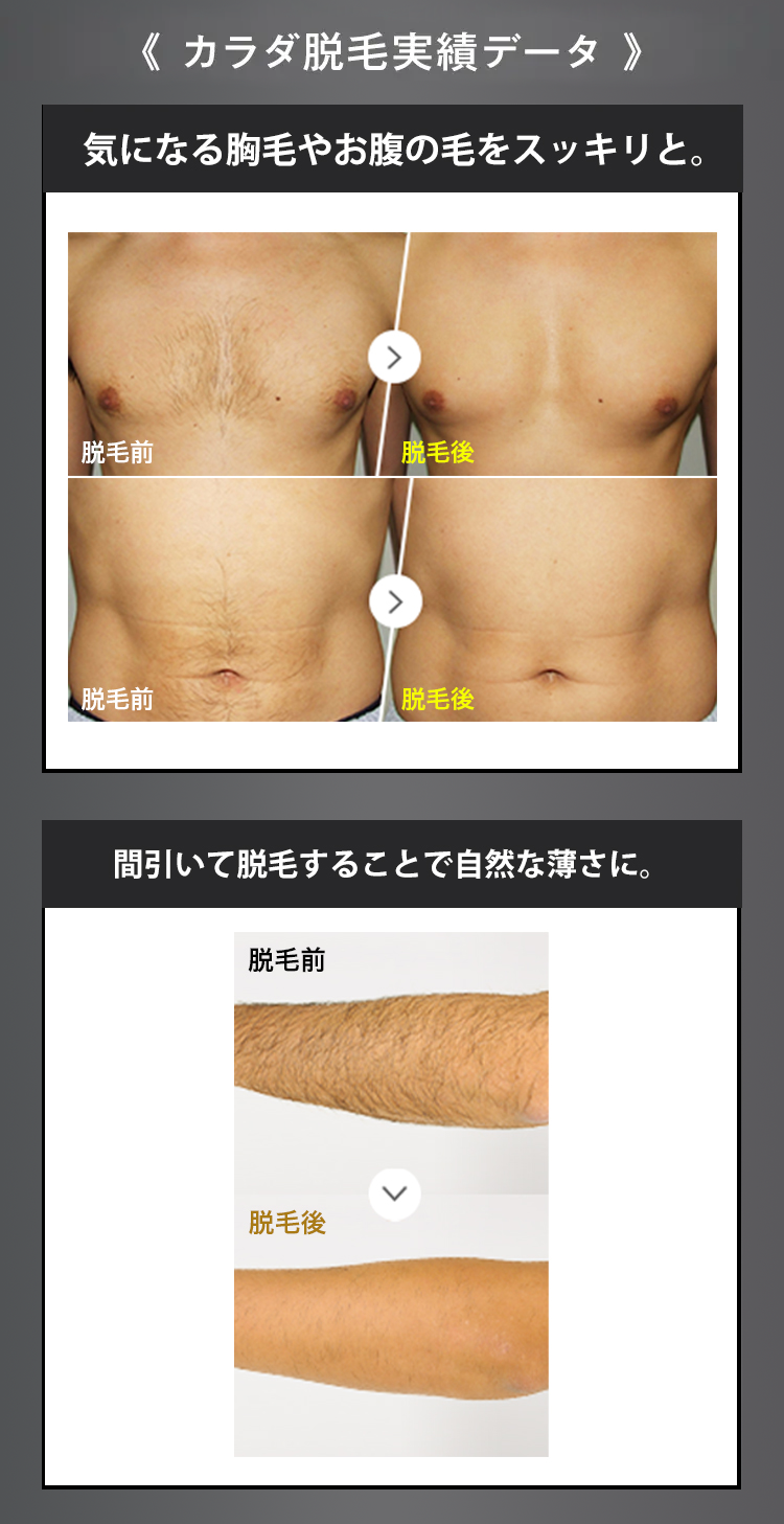 《カラダ脱毛実績データ 》
気になる胸毛やお腹の毛をスッキリと。
脱毛前
脫毛後
脱毛前
脫毛後
間引いて脱毛することで自然な薄さに。
脱毛前
脫毛後