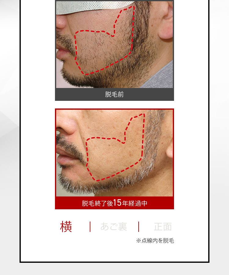 脱毛前
脱毛終了後15年経過中
横 | あご裏 | 正面
※点線内を脱毛