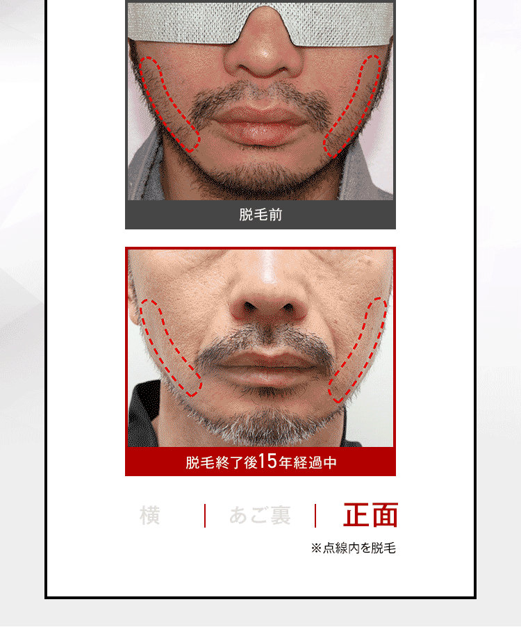 脱毛前
脱毛終了後15年経過中
横 | あご裏 | 正面
※点線内を脱毛