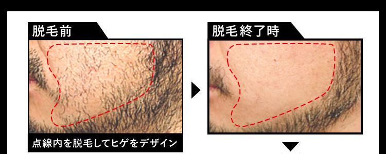 12年経っても生えてきていない実績あり！