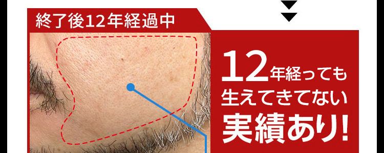 12年経っても生えてきていない実績あり！