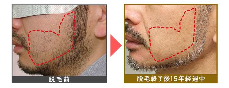 ※点線内を脱毛
脱毛前
脱毛終了後13年経過中