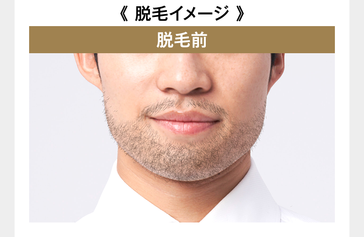 脱毛イメージ(ボタンクリックでポップアップ)