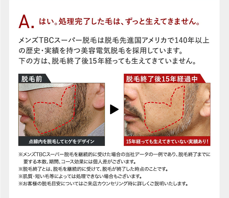はい。処理完了した毛は、ずっと生えてきません。