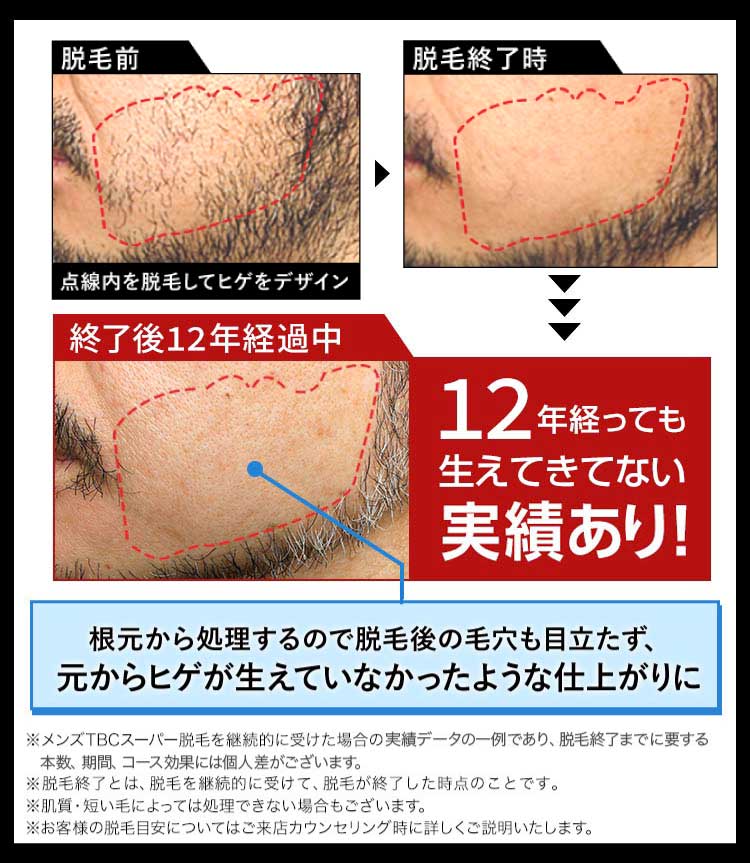 12年経っても生えてきていない実績あり！