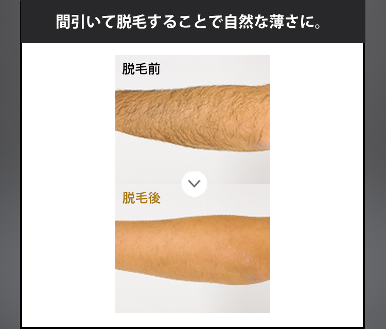 間引いて脱毛することで自然な薄さに。