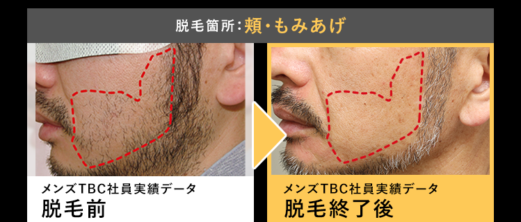 脱毛箇所:頬・もみあげ
メンズTBC社員実績データ
脱毛前
メンズTBC社員実績データ
脱毛終了後
処理完了した毛は
ずっと生えてこない!
脱毛箇所:胸
メンズTBC社員実績データ
メンズTBC社員実績データ
脱毛前
脱毛終了後
※上部写真はメンズTBCスーパー脱毛を継続的に受けた場合の当社社員実績データの一例であり、脱毛終了までに要する本数、 期間、 コー
ス効果には個人差がございます。
※下部写真はメンズTBCスーパー脱毛を継続的に受けた場合の当社データの一例であり、脱毛終了までに要する本数、 期間、 コース効果に
は個人差がございます。
※脱毛終了とは、脱毛を継続的に受けて、 脱毛が終了した時点のことです。
※肌質 短い毛等によっては処理できない場合もございます。
※お客様の脱毛目安についてはご来店カウンセリング時に詳しくご説明いたします。