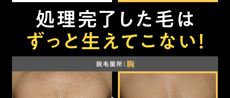 脱毛箇所:頬・もみあげ
メンズTBC社員実績データ
脱毛前
メンズTBC社員実績データ
脱毛終了後
処理完了した毛は
ずっと生えてこない!
脱毛箇所:胸
メンズTBC社員実績データ
メンズTBC社員実績データ
脱毛前
脱毛終了後
※上部写真はメンズTBCスーパー脱毛を継続的に受けた場合の当社社員実績データの一例であり、脱毛終了までに要する本数、 期間、 コー
ス効果には個人差がございます。
※下部写真はメンズTBCスーパー脱毛を継続的に受けた場合の当社データの一例であり、脱毛終了までに要する本数、 期間、 コース効果に
は個人差がございます。
※脱毛終了とは、脱毛を継続的に受けて、 脱毛が終了した時点のことです。
※肌質 短い毛等によっては処理できない場合もございます。
※お客様の脱毛目安についてはご来店カウンセリング時に詳しくご説明いたします。