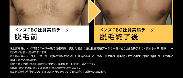 脱毛箇所:頬・もみあげ
メンズTBC社員実績データ
脱毛前
メンズTBC社員実績データ
脱毛終了後
処理完了した毛は
ずっと生えてこない!
脱毛箇所:胸
メンズTBC社員実績データ
メンズTBC社員実績データ
脱毛前
脱毛終了後
※上部写真はメンズTBCスーパー脱毛を継続的に受けた場合の当社社員実績データの一例であり、脱毛終了までに要する本数、 期間、 コー
ス効果には個人差がございます。
※下部写真はメンズTBCスーパー脱毛を継続的に受けた場合の当社データの一例であり、脱毛終了までに要する本数、 期間、 コース効果に
は個人差がございます。
※脱毛終了とは、脱毛を継続的に受けて、 脱毛が終了した時点のことです。
※肌質 短い毛等によっては処理できない場合もございます。
※お客様の脱毛目安についてはご来店カウンセリング時に詳しくご説明いたします。
